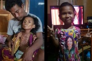 Bocah Penderita Gizi Buruk Di Jeneponto Membaik